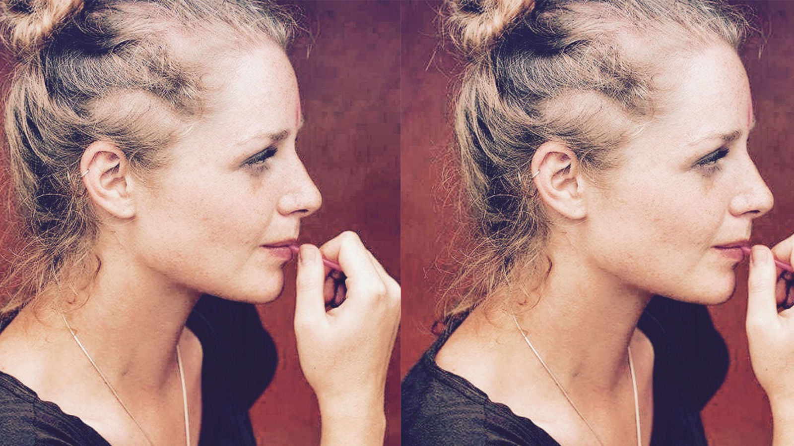 Top 10 Crazy Solutions For Thyroid Hair Loss In Avonside 2628 Nsw